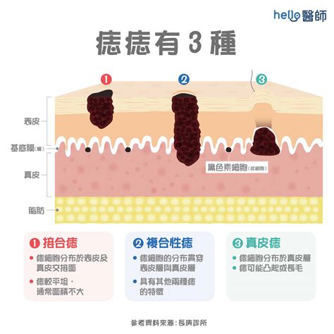 身體多痣|痣是什麼？一次了解痣原因、就醫時機以及如何改善